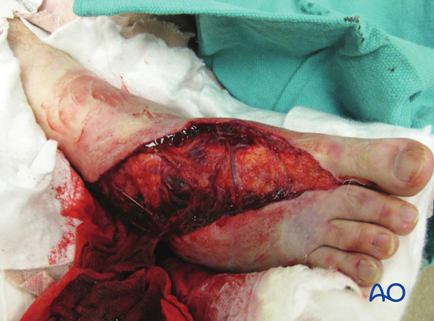 combined hindfoot injuries