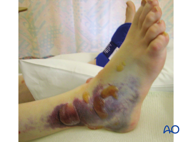 combined hindfoot injuries