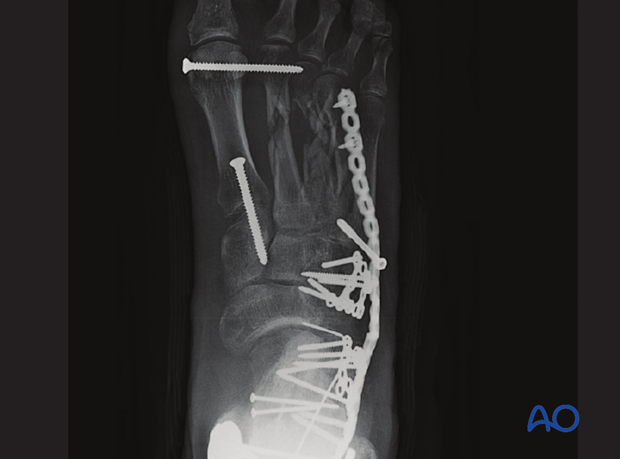 Severe open hindfoot injury