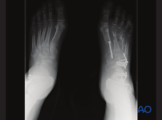 Severe open hindfoot injury
