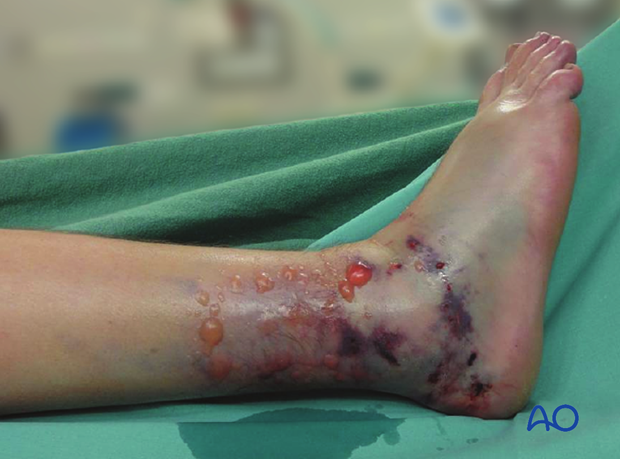 Clinical presentation of compartment syndrome of the foot