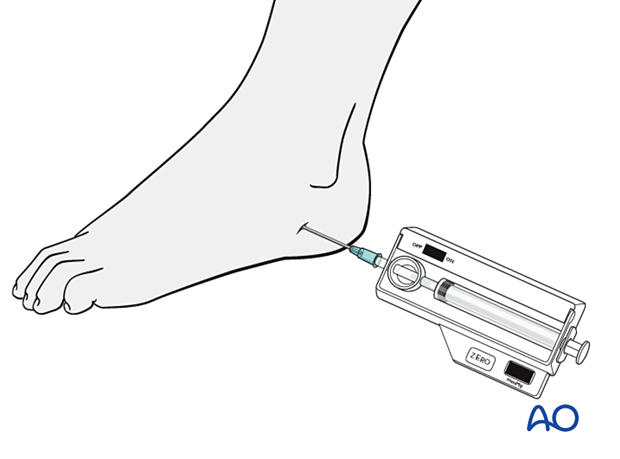 Foot compartment pressure monitoring