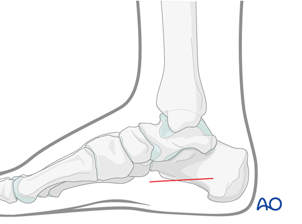 Medial incision to treat foot compartment syndrome