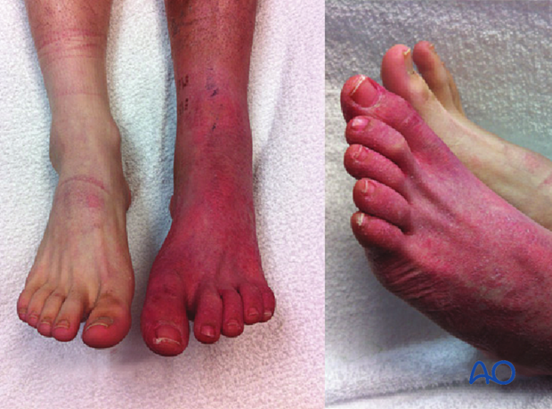 Long-term sequelae of foot compartment syndrome