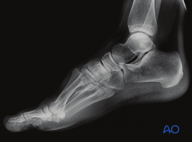 This lateral x-ray shows a subtle dorsal positioning of a metatarsal base.