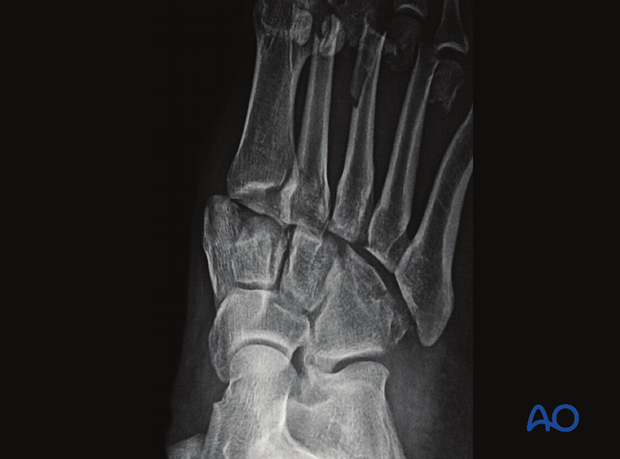 Lateral displacement of 4th metatarsal on the cuboid