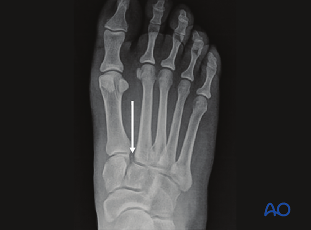 Malalignment at the medial border of intermediate cuneiform and the 2nd metatarsal
