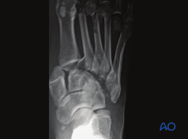Lateral displacement of 4th metatarsal on the cuboid