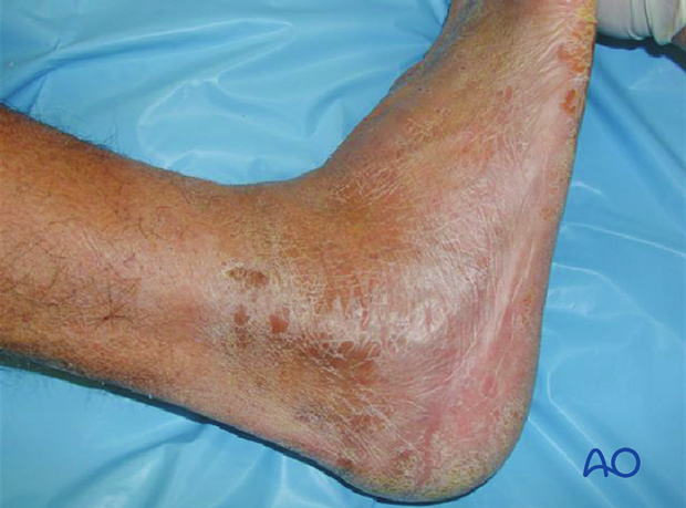 Soft-tissue “wrinkle sign” in an injured foot