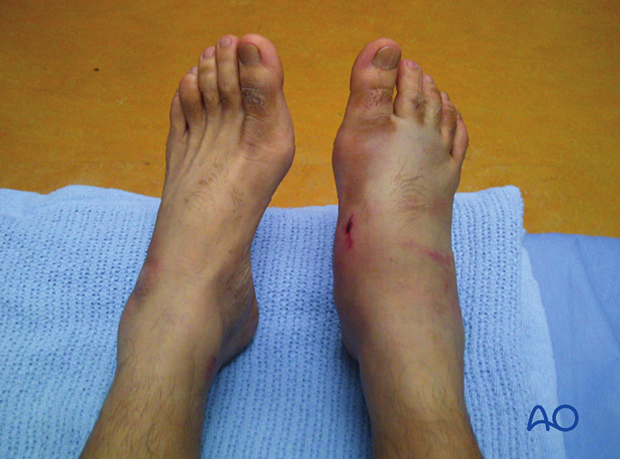 There is swelling, bruising, and point tenderness at the dorsolateral aspect of the foot.