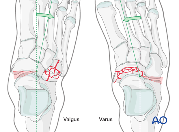Valgus and varus dislocated Chopart joint