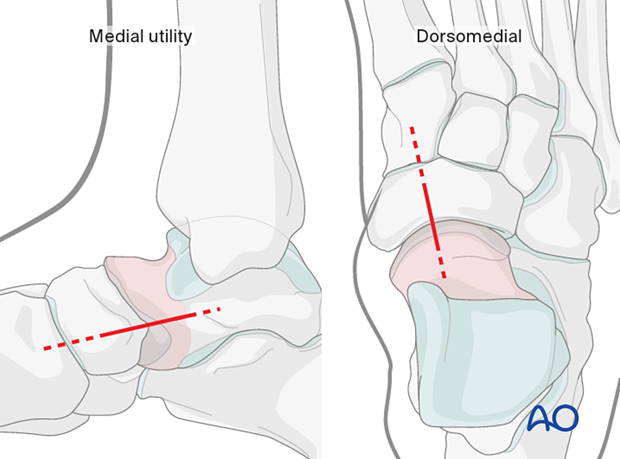 Skin incisions for medial utility approach and dorsomedial approach to the navicular and talar head