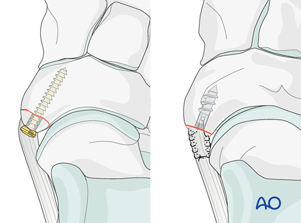 Lag screw and suture anchor fixation of a navicular avulsion