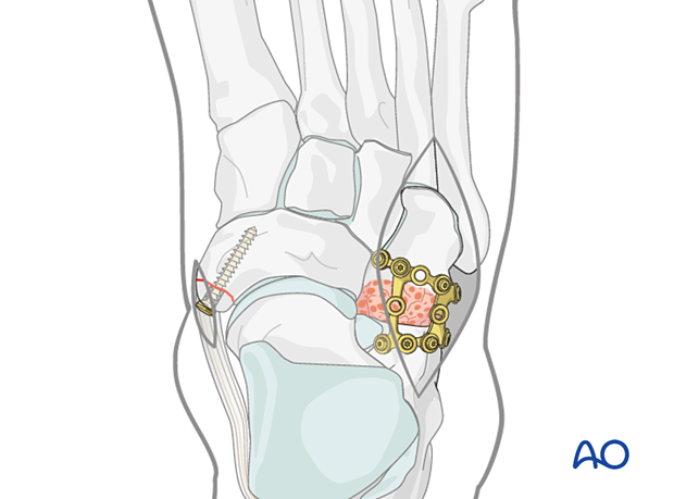 Lag screw fixation of a navicular avulsion and fusion of the calcaneocuboid joint