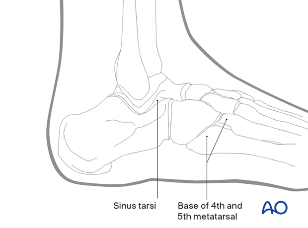 Bony anatomical landmarks of dorsolateral approach to the cuboid
