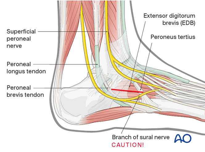 Dorsolateral approach to the midfoot