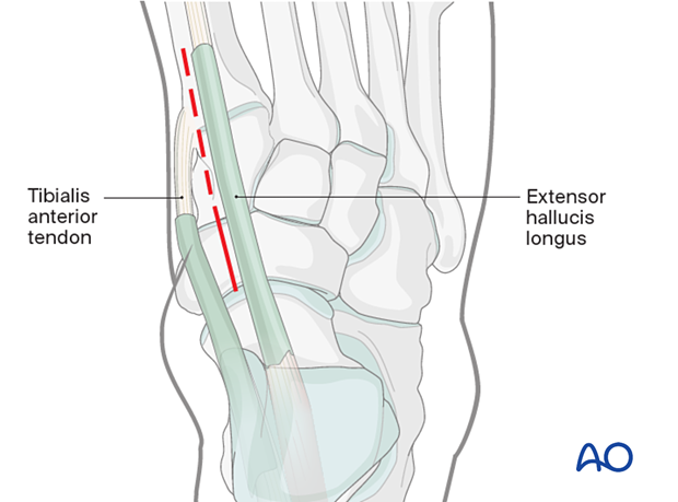 Distal extension of a dorsomedial approach to the navicular