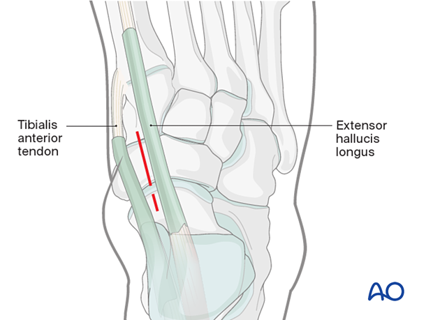 Proximal extension of a dorsomedial approach to the navicular