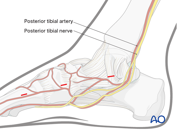 Additional medial stab incisions in a dorsomedial approach