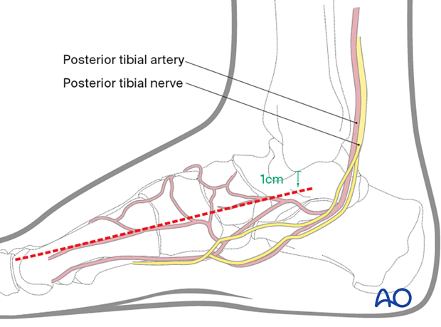 Structures accessed through medial utility incision to the navicular