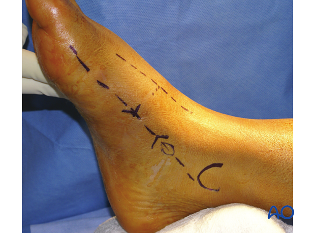 Medial utility incision to the navicular