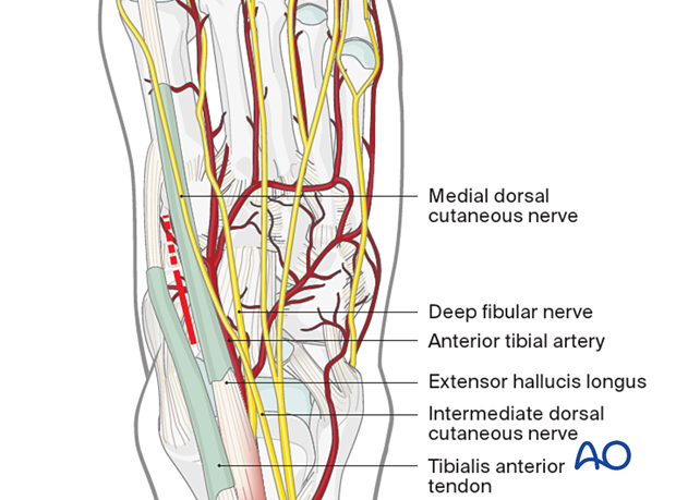 Additional dorsomedial incision to the medial utility incision to the navicular