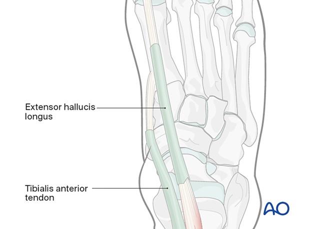 The percutaneous dorsomedial approach to the navicular is made between the tibialis anterior tendon and the extensor hallucis longus (EHL) tendon