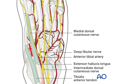 Percutaneous Approach To The Navicular