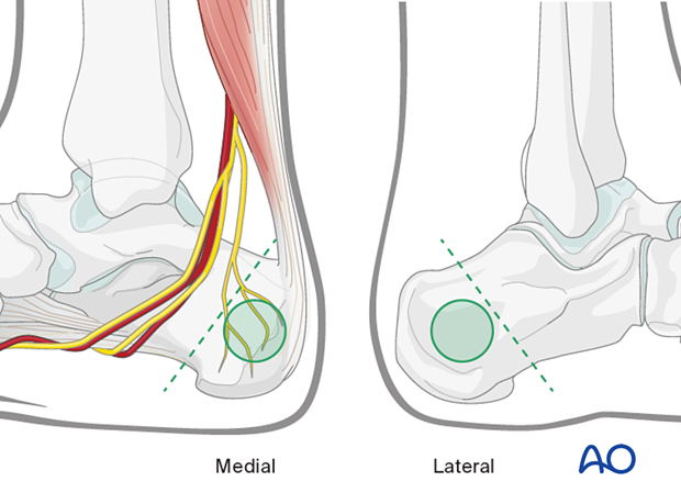 Safe zones for pins and K-wires insertion in the calcaneum