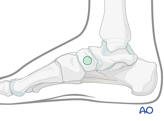 Medial safe zone for pins and K-wires insertion in the navicular