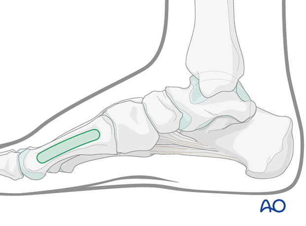 Safe zone for pins and K-wires insertion in the medial aspect of the first metatarsal