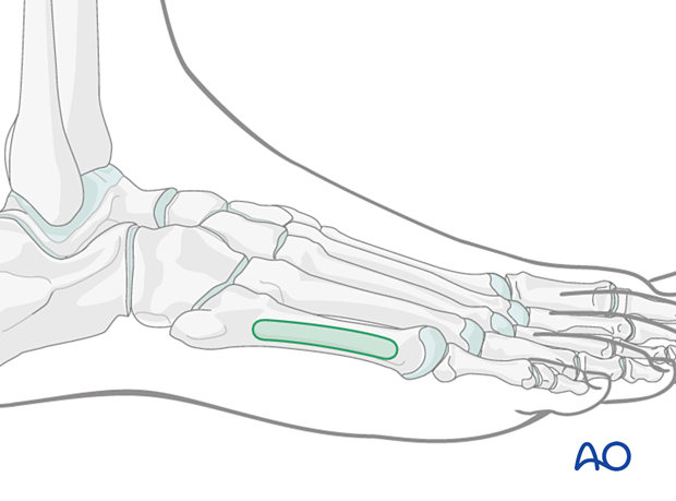 Safe zone for pins and K-wires insertion in the fifth metatarsal