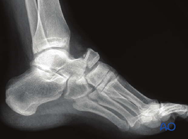 Lateral x-ray showing a simple Chopart joint injury