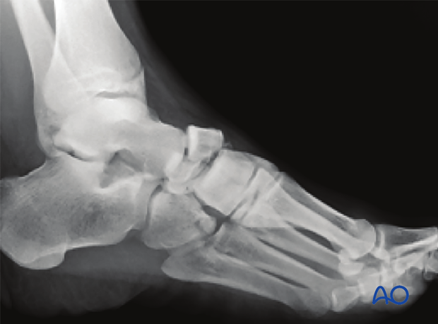 This image shows a multi fragmentary navicular fracture with dorsal avulsion
