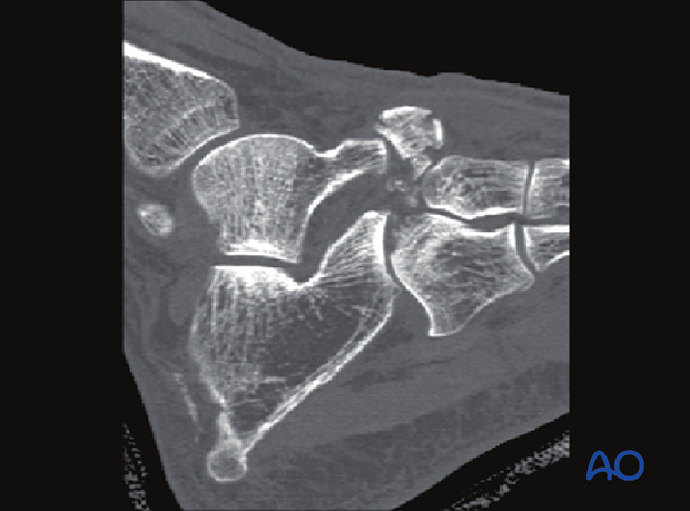 CT image showing a fracture dislocation of the Chopart joint