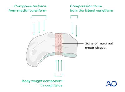 Nonoperative treatment for Navicular avulsion fracture