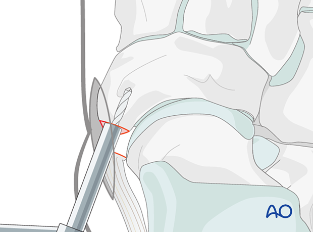 Drilling for suture anchor fixation of a navicular avulsion fracture
