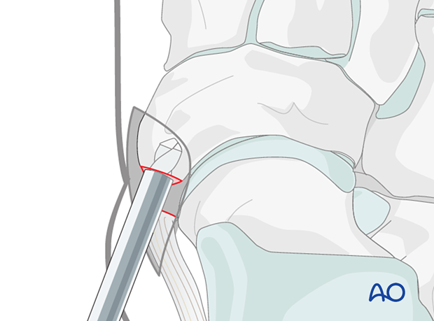 Drilling for suture fixation of a navicular avulsion fracture