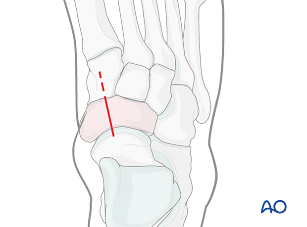 Limited incision for a dorsomedial approach to the navicular and cuneiform