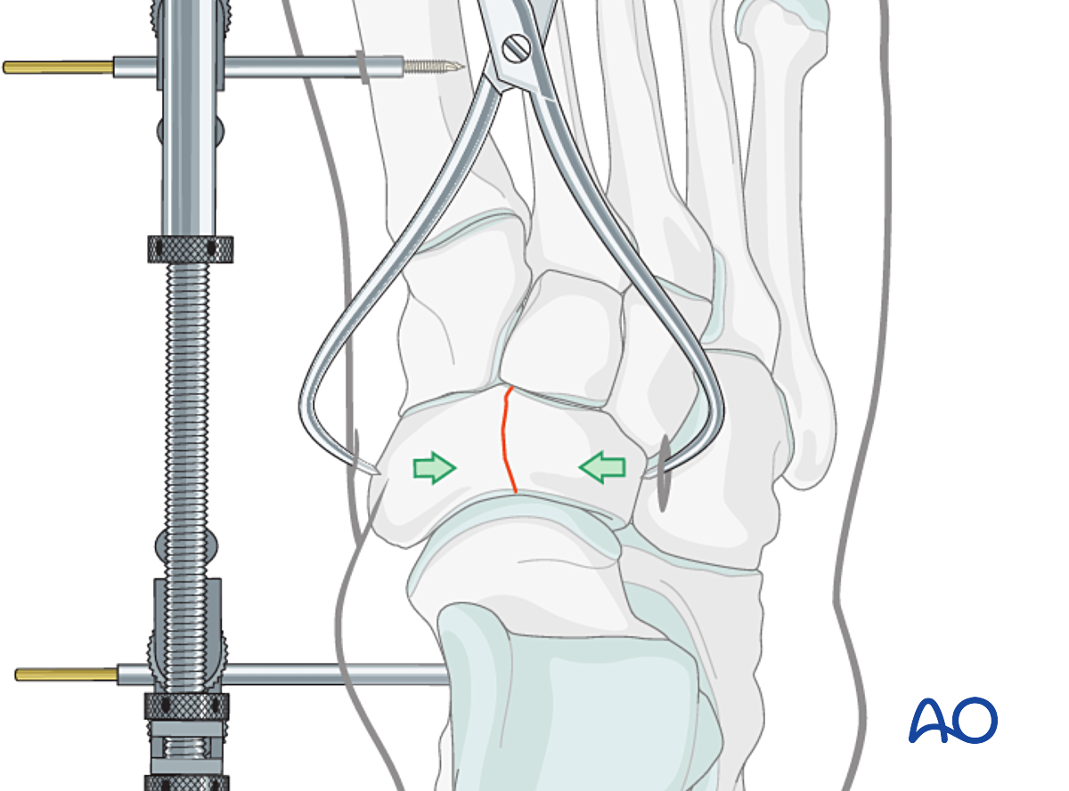 Lag Screw Of Simple Complete Navicular Fracture Lag Screw Of Simple Complete Navicular Fracture