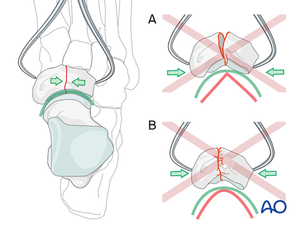 Reduction of a complete articular navicular fracture with reduction forceps