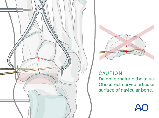 Preliminary K-wire fixation to hold the reduction of a complete articular navicular fracture