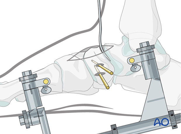 Preliminary K-wire fixation to hold the reduction of a complete articular navicular fracture