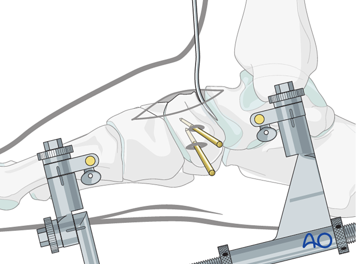 Lag Screw Of Simple Complete Navicular Fracture Lag Screw Of Simple Complete Navicular Fracture