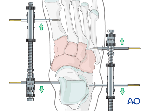 Medial and lateral external fixation with a distractor device to restore columnar length