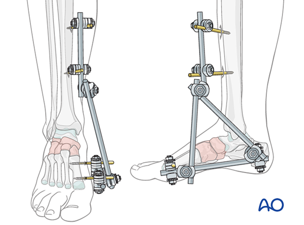 Temporary cross ankle external fixation from the distal tibia to the metatarsals