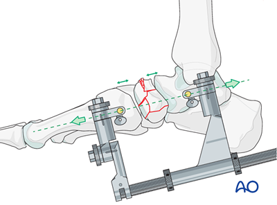 ORIF - Navicular plate for Complete articular navicular fracture