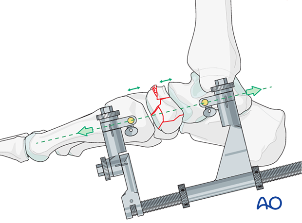 Application of distraction with a medial-column distractor for reduction of a multifragmentary articular navicular fracture