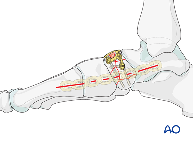 Planning for a medial bridge plate to protect navicular plate fixation of a multifragmentary articular navicular fracture