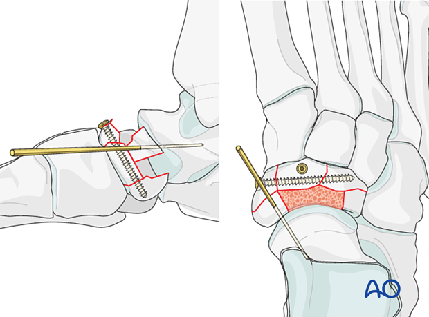 Screw fixation of the naviculocuneiform articular fragments